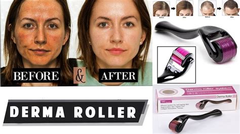 dermaroller before after|What to Use Before and After Dermaroller to Get the .